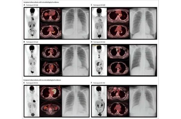 Novel approach identifies people at risk of developing TB